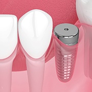 osseointegration:Digital illustration of a dental implant