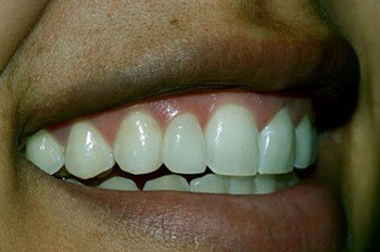 Reshaped front tooth