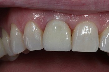 Flawlessly repaired front tooth