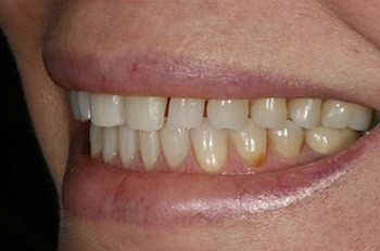Side teeth with large gaps