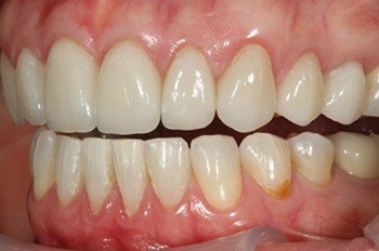 Top teeth with perfect spacing