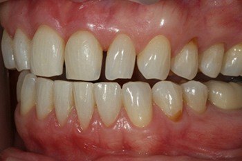 Top teeth with tooth much space between
