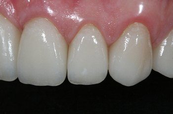 Reshaped flawless front tooth