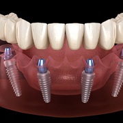 3D illustration of All-on-X dentures