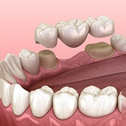 A traditional dental bridge in Pepper Pike