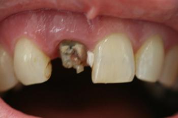 Severely decayed front tooth