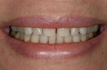 Smile with gap between front teeth