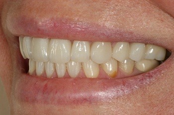Side teeth with flawless spacing