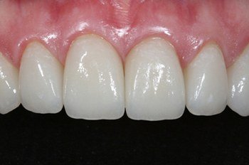 Closed gap between front teeth