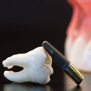 Model of a natural tooth and a dental implant post