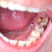 A severely decayed tooth in Pepper Pike