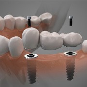 Digital illustration of a dental implant bridge