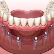 Digital illustration of an implant denture