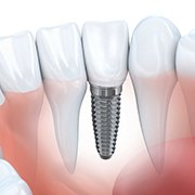 Animated dental implant supported dental crown