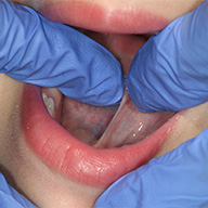 Closeup of a lip tie in Cleveland