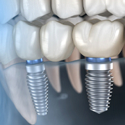 Closeup illustration of three-unit dental implant bridge