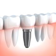 A single tooth dental implant supported dental crown