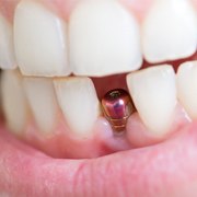 A person with a dental implant post visible in their mouth