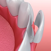 Illustration of a porcelain veneer placement