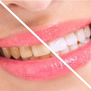 Close up of smile before and after teeth whitening 