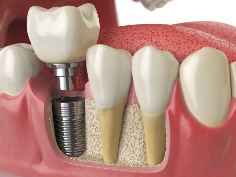 a digital image of a dental implant sitting along the bottom arch of teeth
