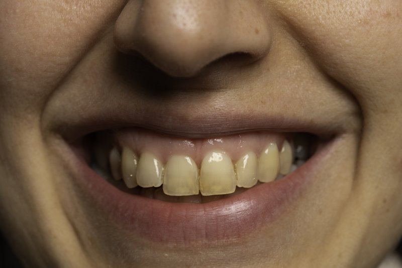 An up-close image of a person’s mouth and their stained teeth
