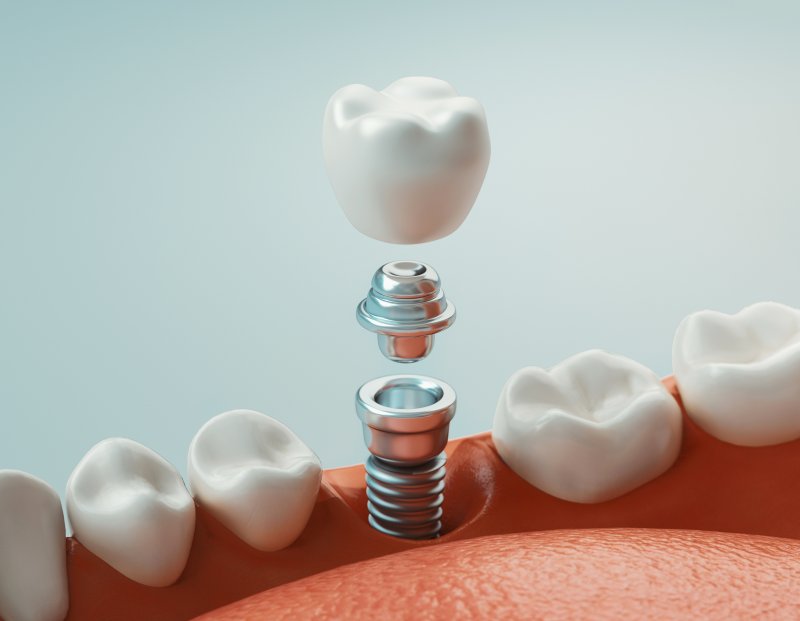 3-D model of a dental implant